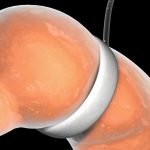 Bariatric Surgeries
