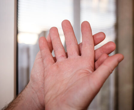 Warts on the Hands: Common Causes and Treatment Options